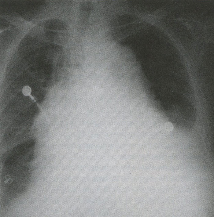 Рентгенограмма 