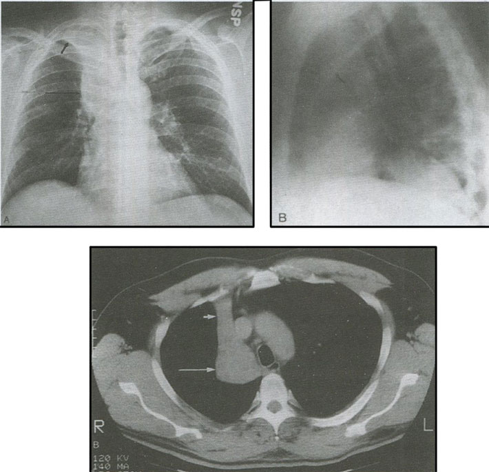 Рентгенограммы органов грудной клетки