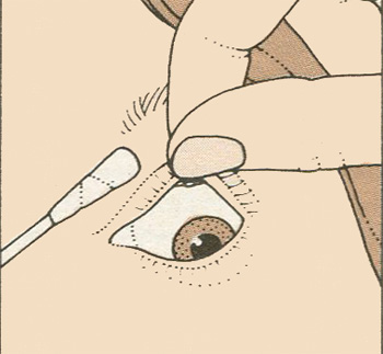 Попадание в глаз инородного тела