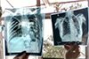 Рентгенография: Кисты и кистоподобные образования в легких