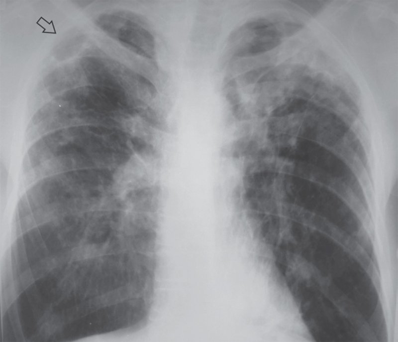 Хронический диссеминированный туберкулез легких
