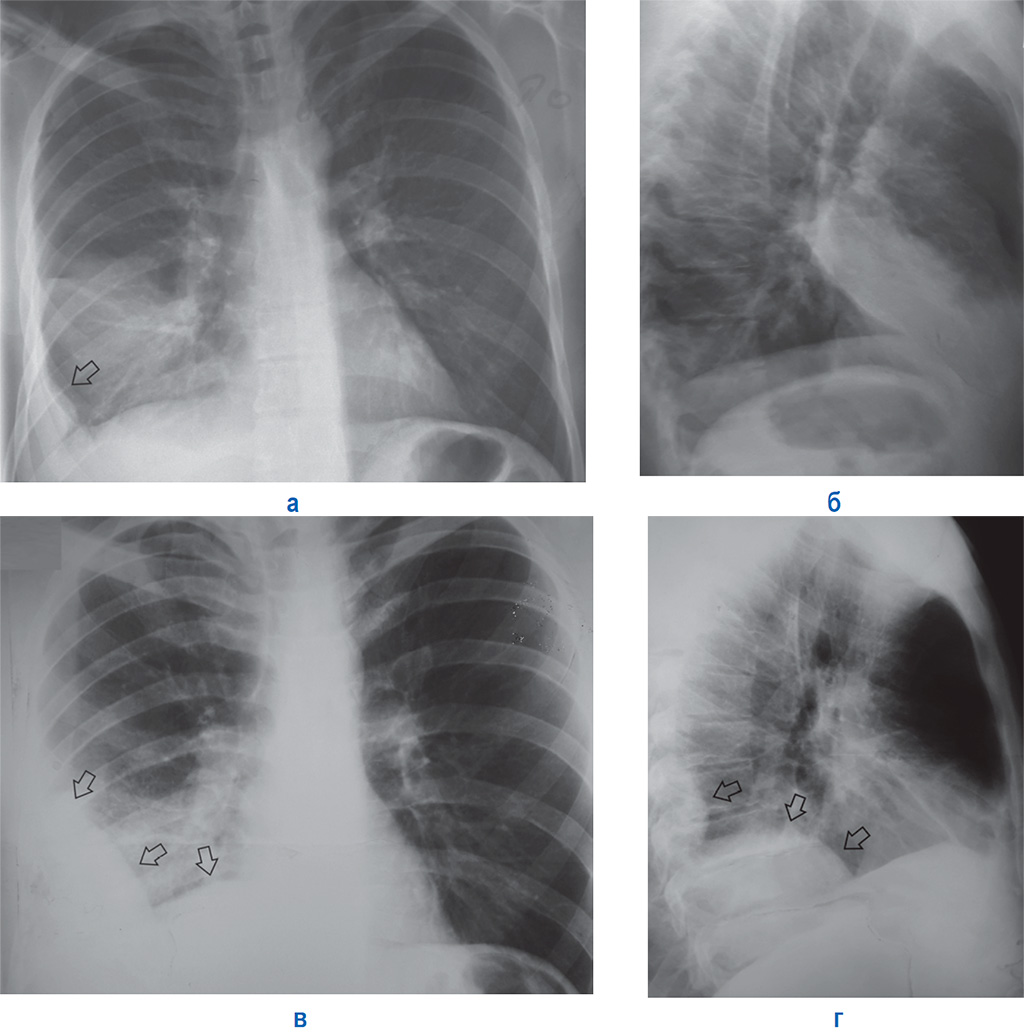 Плеврит легких на рентгене фото