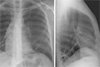 Рентгенологический атлас: Пневмония