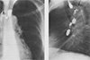 Рентгенологический атлас: Инфекционная Деструкция Легких