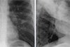 Рентгенологический атлас: Туберкулез Легких
