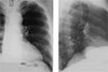 Рентгенологический атлас: Изменения Диафрагмы и Поддиафрагмального пространства