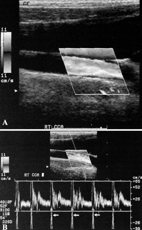 Допплерография сонной артерии: артефакт смешивания
