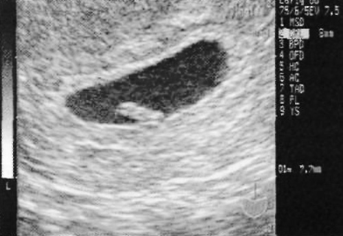 УЗИ: Измерение эмбрионального полюса