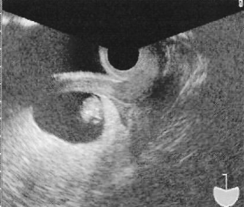 УЗИ: внутриматочное скопление крови над внутренним зевом шейки матки с полным предлежанием плаценты на задней стенке матки