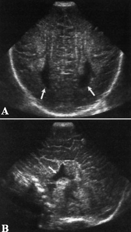 УЗИ: Агенезия мозолистого тела у недоношенного ребенка