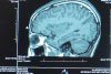 МРТ сосудов мозга и шеи