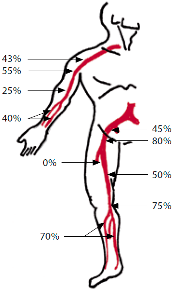 частота ампутаций после наложения лигатур на артерии